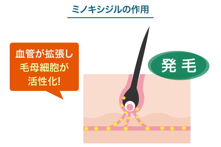 福島・本宮市の薄毛治療アークAGAクリニックが発毛を促進を解説